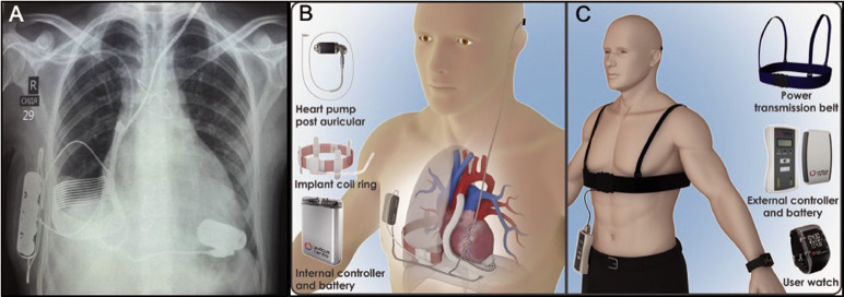 kalp pompası