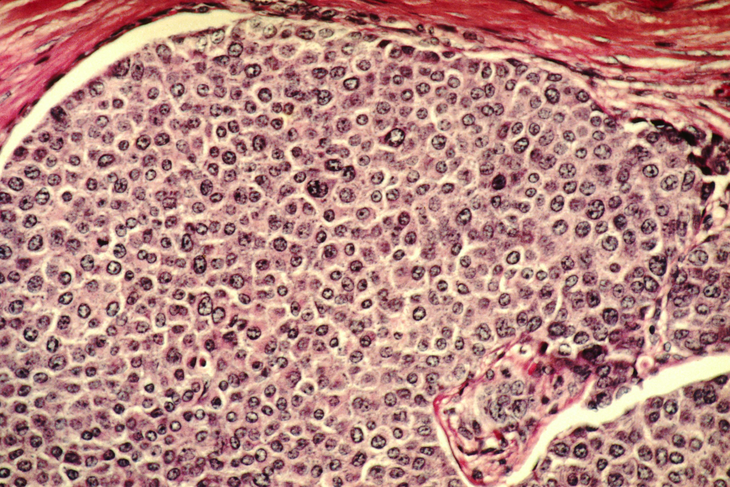 Breast cancer cells scaled
