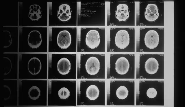 Alzheimer’a Umut Doğdu! Bilim İnsanları Hastalığı Geciktirmenin Yollarını Buldu Mu?